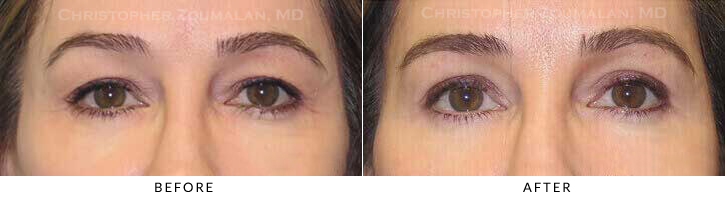 Upper Lid Blepharoplasty Before & After Photo - Patient Seeing Straight - Patient 37A