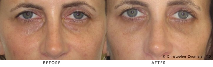 Brightening Under Eye Cream - Remove Dark Circles Eye Bags Wrinkles Puffy  Eyes | eBay
