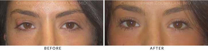 Benign Eyelid Lesions Before And After Photo Gallery 