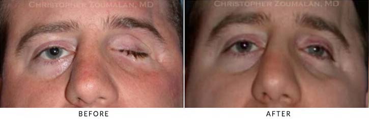 Eye Socket Orbital Surgery Before And After Photo Gallery