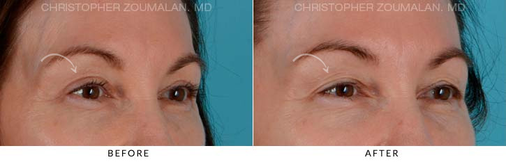 Upper Lid Blepharoplasty Before And After Photo Gallery 