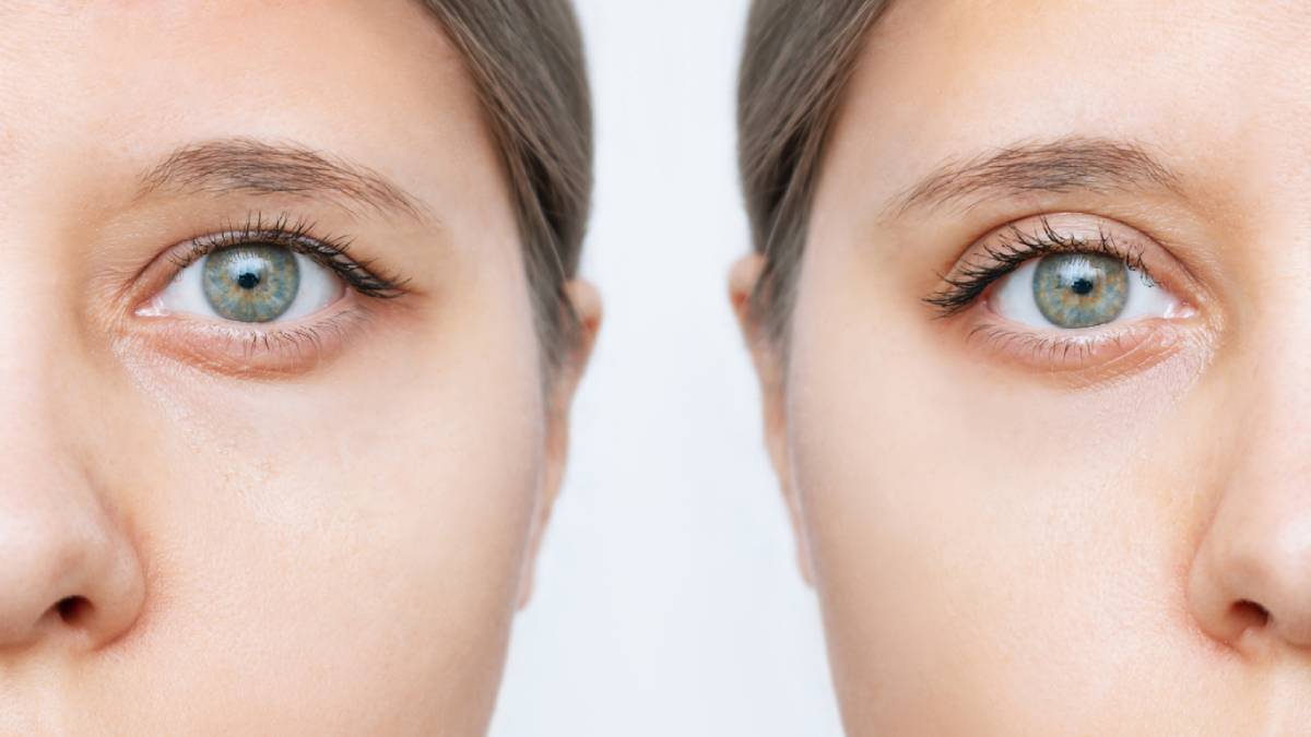 Featured image for How Long Will It Take to See the Final Results of Upper Blepharoplasty